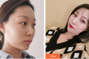 福州市第八人民醫(yī)院整形美容科王世健整形價(jià)格表附抗衰案例展示