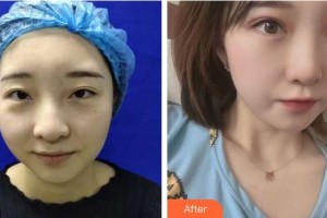 福州眼科醫(yī)院張文淑整形價(jià)格表附美眼/大眼看未來案例展示