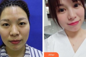 福州眼科醫(yī)院關(guān)照整形價(jià)格表附眼部綜合案例展示