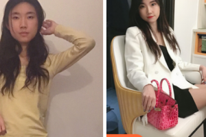 宜昌博美醫(yī)療美容醫(yī)院牛平整形價(jià)格表附光子嫩膚案例展示