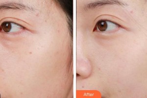 安徽維多利亞整形外科醫(yī)院鐘峰整形價格表附激光美膚激光祛斑案例展示