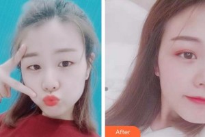 安徽立新醫(yī)學(xué)美容門診部周著祖整形價格表附雙眼皮案例展示
