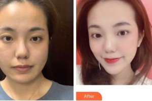 安徽韓美整形美容醫(yī)院石顯武整形價格表附埋線提升提升案例展示