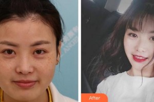 安徽立新醫(yī)學(xué)美容門診部楊義整形價格表附激光美膚激光案例展示