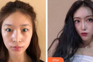 安徽立新醫(yī)學(xué)美容門診部朱慧茹整形價格表附切開雙眼皮案例展示