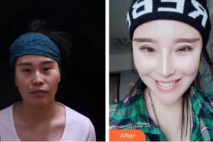 安徽立新醫(yī)學(xué)美容門診部李戰(zhàn)強(qiáng)整形價(jià)格表附鼻部手術(shù)案例展示