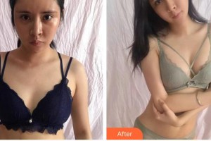 安徽醫(yī)科大學(xué)第二附屬醫(yī)院整形美容中心曹東升整形價(jià)格表附隆胸案例展示