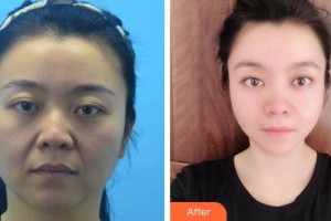 安徽立新醫(yī)學(xué)美容門診部楊鵬整形價(jià)格表附埋線提升案例展示