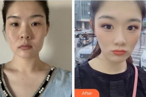 安徽醫(yī)科大學(xué)第二附屬醫(yī)院整形美容中心謝娟整形價(jià)格表附面部年輕化案例展示