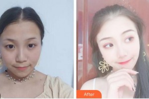 安徽醫(yī)科大學(xué)第二附屬醫(yī)院整形美容中心丁浩整形價(jià)格表附埋線提升案例展示