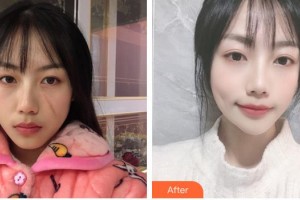 安徽醫(yī)科大學(xué)第一附屬醫(yī)院整形美容中心趙宇整形價(jià)格表附祛疤案例展示