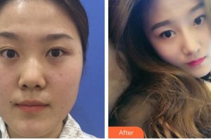 安徽韓美整形美容醫(yī)院金升俊整形價(jià)格表附隆鼻案例展示