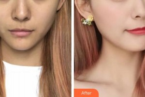 安徽韓美整形美容醫(yī)院吳鳳芝整形價(jià)格表附超激光美膚案例展示