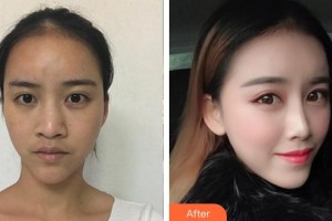 安徽醫(yī)科大學(xué)第一附屬醫(yī)院整形美容中心寧金龍整形價(jià)格表附鼻部手術(shù)案例展示
