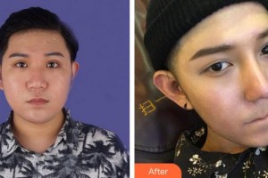 安徽醫(yī)科大學(xué)第一附屬醫(yī)院整形美容中心李小靜整形價(jià)格表附鼻部整形案例展示