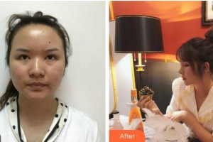 安徽醫(yī)科大學(xué)第一附屬醫(yī)院整形美容中心高學(xué)宏整形價(jià)格表附鼻部手術(shù)日記案例展示