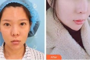 安徽醫(yī)科大學(xué)第一附屬醫(yī)院整形美容中心張林整形價(jià)格表附網(wǎng)紅鼻部手術(shù)案例展示