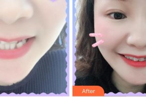 安徽長(zhǎng)征微創(chuàng)外科醫(yī)院整形美容科張智整形價(jià)格表附牙齒矯正案例展示