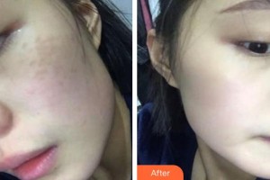 安徽長(zhǎng)征微創(chuàng)外科醫(yī)院整形美容科何燕整形價(jià)格表附超激光美膚案例展示