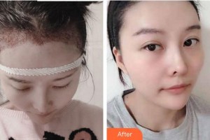 安徽長(zhǎng)征微創(chuàng)外科醫(yī)院整形美容科邸偉整形價(jià)格表附發(fā)際線案例展示