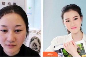 江蘇百年植發(fā)醫(yī)院王燦領(lǐng)整形價(jià)格表附植發(fā)案例展示