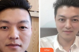 銅陵愛(ài)爾眼科醫(yī)院陶小林整形價(jià)格表附切開(kāi)雙眼皮案例展示