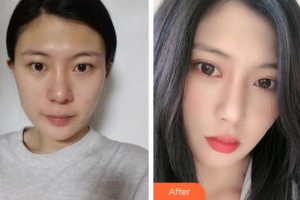 銅陵愛(ài)爾眼科醫(yī)院王莉勇整形價(jià)格表附眼部綜合案例展示