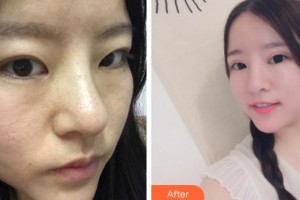 安慶亞星醫(yī)療美容門(mén)診部劉一正整形價(jià)格表附切開(kāi)雙眼皮案例展示