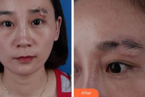 安慶亞星醫(yī)療美容門(mén)診部楊帆整形價(jià)格表附微創(chuàng)疤痕修復(fù)案例展示