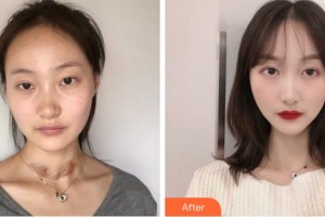 安慶維多利亞醫(yī)療美容門(mén)診部彭鵬整形價(jià)格表附祛疤案例展示