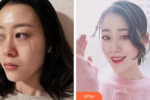 安慶維多利亞醫(yī)療美容門(mén)診部喬瑞整形價(jià)格表附激光祛疤案例展示