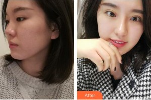 安慶施漢彬愛(ài)爾眼科醫(yī)院施漢彬整形價(jià)格表附眼部綜合案例展示