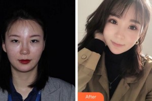 安慶市第二人民醫(yī)院眼科袁俊整形價(jià)格表附切開(kāi)雙眼皮案例展示