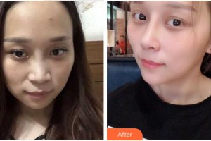 黃山心藝醫(yī)療美容門(mén)診部張斌斌整形價(jià)格表附肋軟骨隆鼻案例展示