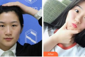 黃山市第三人民醫(yī)院眼科李盈龍整形價(jià)格表附雙眼皮案例展示