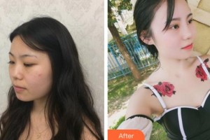 黃山市第三人民醫(yī)院眼科江啟孝整形價(jià)格表附眼部綜合案例展示