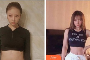 滁州市第一人民醫(yī)院燒傷整形科姚廣東整形價(jià)格表附微創(chuàng)疤痕修復(fù)案例展示