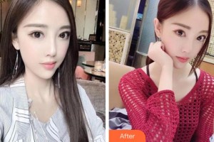 滁州市中西醫(yī)結(jié)合醫(yī)院眼科趙波整形價(jià)格表附眼部綜合案例展示