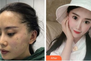 阜陽(yáng)東方美萊塢醫(yī)療美容醫(yī)院張小瑞整形價(jià)格表附熱瑪吉案例展示