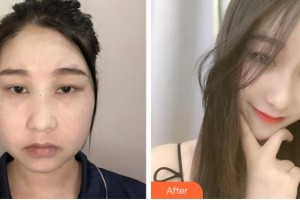 阜陽(yáng)市人民醫(yī)院整形美容外科方建強(qiáng)住院醫(yī)師整形價(jià)格表附埋線(xiàn)提升案例展示