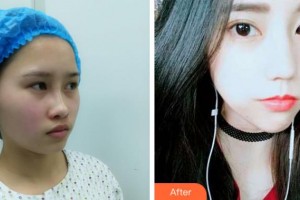 阜陽(yáng)皮膚病醫(yī)院醫(yī)療美容科王世明整形價(jià)格表附埋線(xiàn)提升案例展示