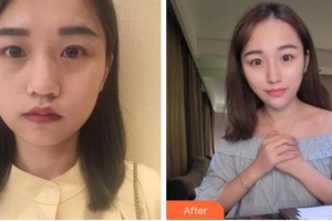 阜陽(yáng)東方美萊塢醫(yī)療美容醫(yī)院劉小俠整形價(jià)格表附抗衰案例展示