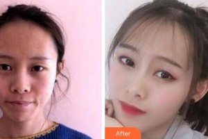 阜陽(yáng)楊鈞美容整形門(mén)診部楊利整形價(jià)格表附埋線(xiàn)提升案例展示