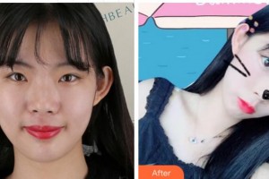 阜陽(yáng)婦女兒童醫(yī)院整形美容外科李忠民整形價(jià)格表附熱瑪吉案例展示