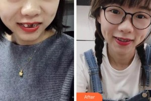 阜陽(yáng)愛(ài)齒口腔門(mén)診部李云安整形價(jià)格表附金屬托槽矯正案例展示