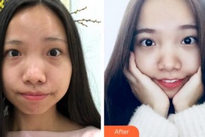 阜陽七院愛爾眼科醫(yī)院儲彪整形價格表附激光去眼袋案例展示