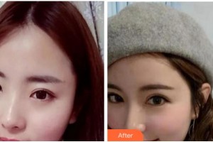 阜陽愛齒口腔門診部馬厚明整形價格表附眼部修復(fù)案例展示