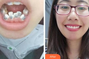 阜陽愛齒口腔門診部張士彬整形價格表附金屬托槽矯正案例展示