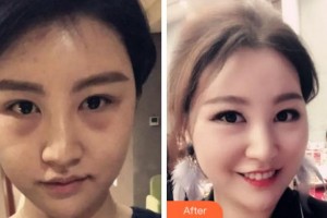 阜陽澤明眼科醫(yī)院鹿秀蘭整形價格表附內(nèi)切祛眼袋案例展示