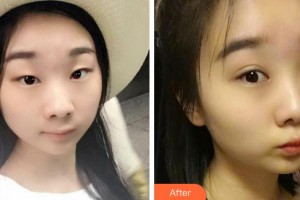 阜陽澤明眼科醫(yī)院陳曉艷整形價格表附切開雙眼皮案例展示